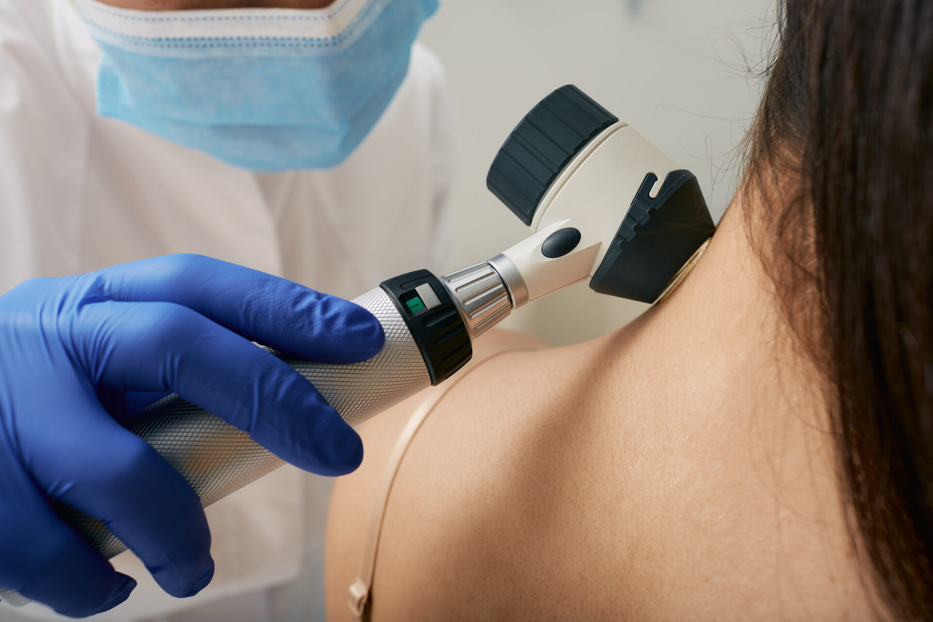Mole dermatoscopy. Doctor examines the patient's mole with a dermatoscope for prevention of melanoma, close-up.