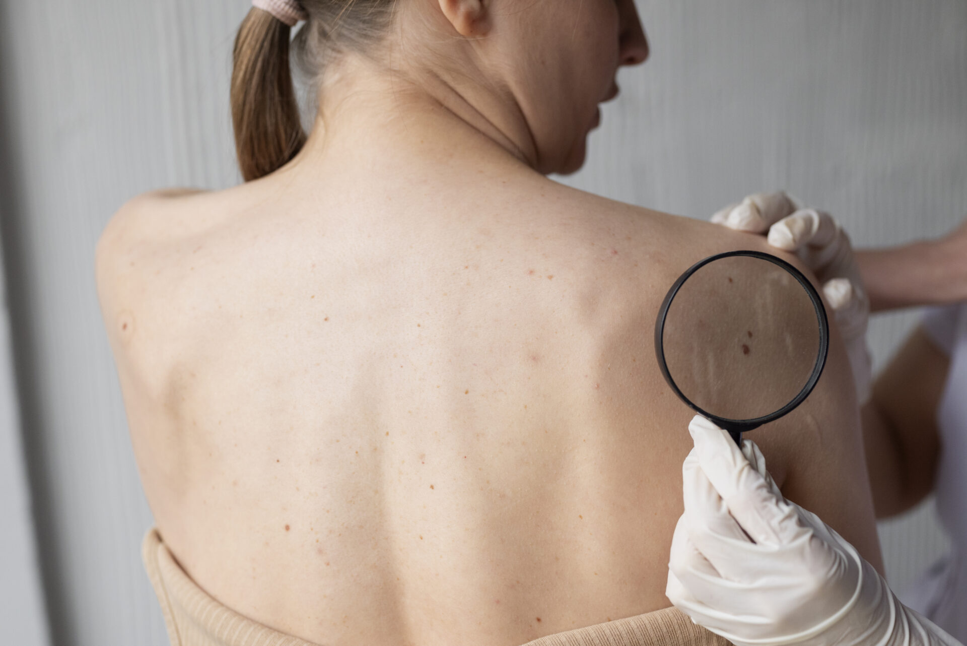 medico-femminile-che-diagnostica-un-melanoma-sul-corpo-di-una-paziente-di-sesso-femminile